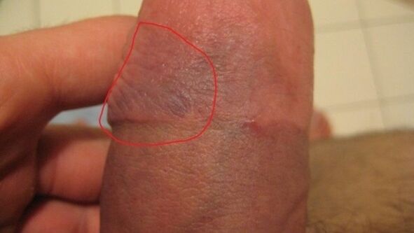 bruise on penis after vacuum pump