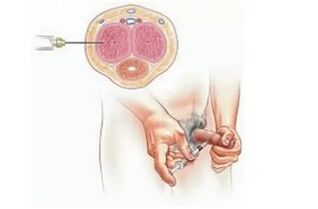 Penis enlargement injection