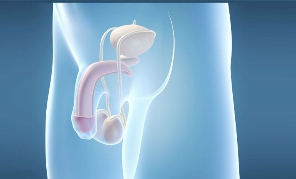 Penile prosthesis implantation is a surgical method to increase the size of the male penis